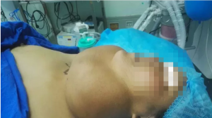病例讨论:巨大甲状腺肿瘤切除术的麻醉处理